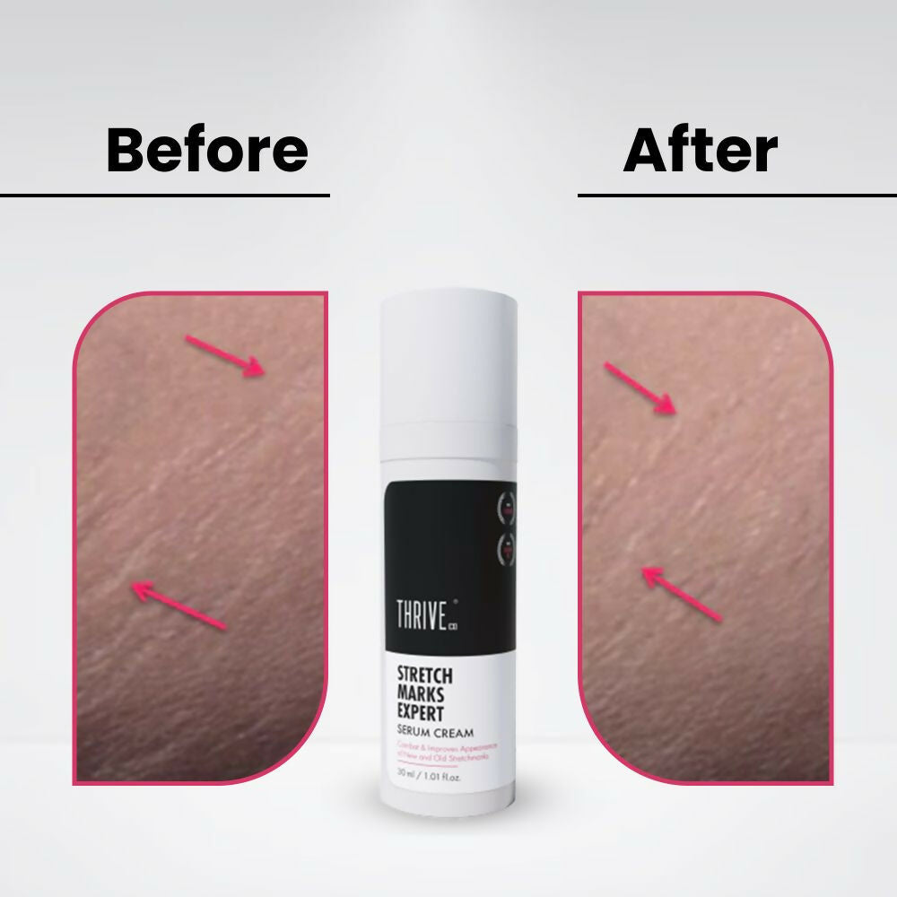 ThriveCo Stretch Marks Expert Serum Cream - Distacart