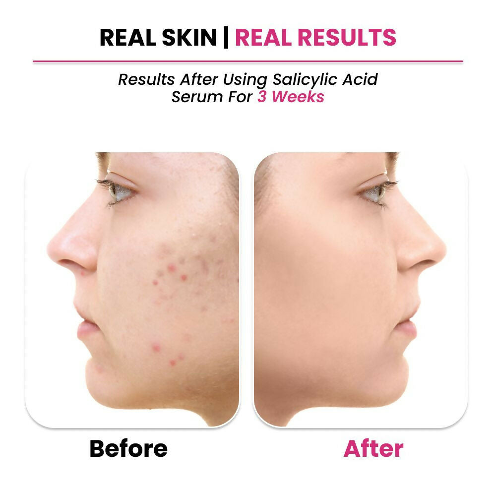 ThriveCo 2% Salicylic acid Serum - Distacart