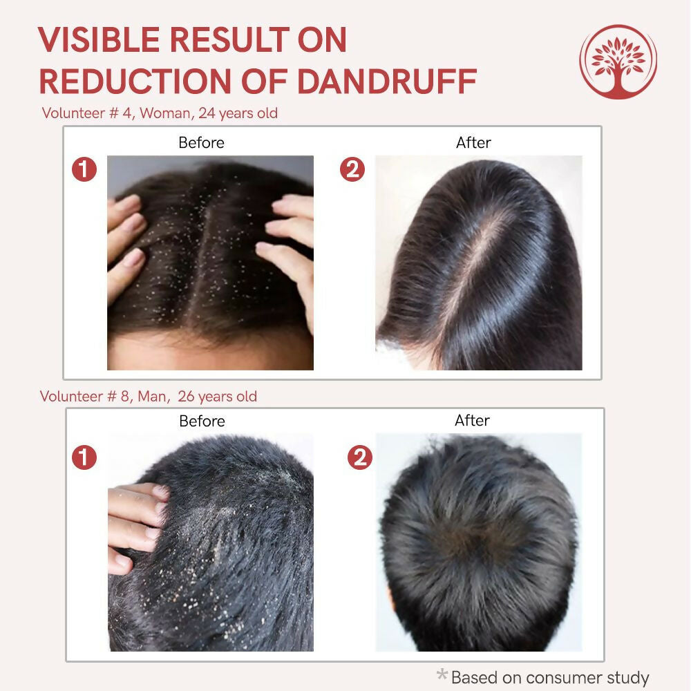 Ivory Natural Dandruff Hair Serum For Nourishing Dry Scalp - Distacart