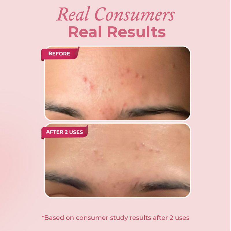 The Pink Foundry Acne Spot Corrector With Salicylic Acid For Active Acne Blackheads & Whiteheads - Distacart