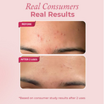 Thumbnail for The Pink Foundry Acne Spot Corrector With Salicylic Acid For Active Acne Blackheads & Whiteheads - Distacart