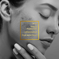 Thumbnail for VLCC Clinic Acne Control Regime CSMS (Cleanser, Serum, Moisturizer, Sunscreen) For Acne Care Combo