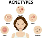 Thumbnail for Ipca Acne UV Gel SPF 50 - Distacart