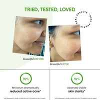 Thumbnail for Dot & Key 2% Salicylic + Zinc Acne Busting Face Serum For Acne & Oil Control - Distacart