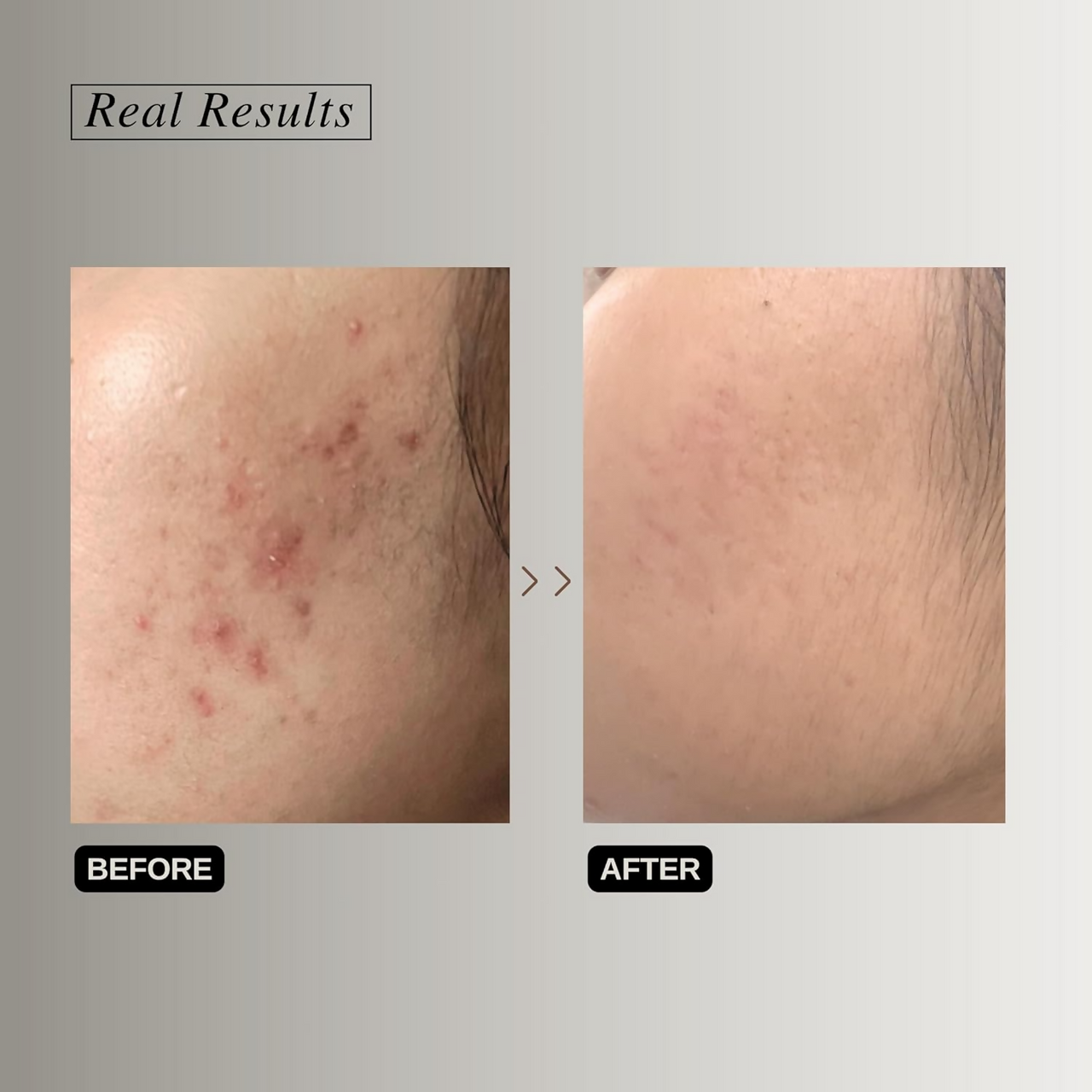 The Formularx Renaissance Gentle Retinol Complex Serum With Niacinamide & Bakuchiol