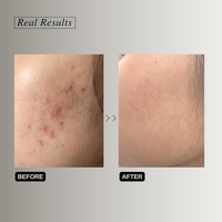 Thumbnail for The Formularx Renaissance Gentle Retinol Complex Serum With Niacinamide & Bakuchiol