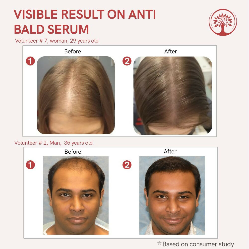 Ivory Natural Bald Serum For Baldness, Hair Thinning And Hair Fall - Distacart