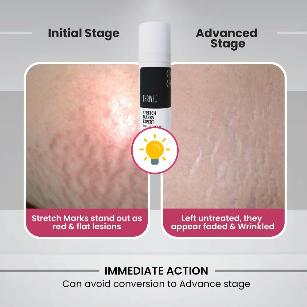 ThriveCo Stretch Marks Expert Serum Cream - Distacart