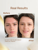 Thumbnail for Anti Acne Serum 7 (1)