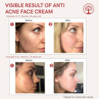 Thumbnail for Ivory Natural Acne Face Cream For Acne Free Face - Distacart