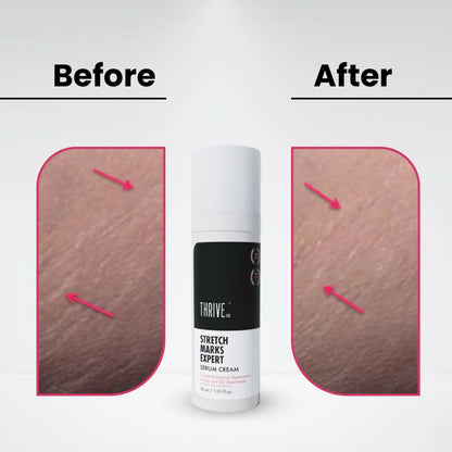 ThriveCo Stretch Marks Expert Serum Cream - Distacart