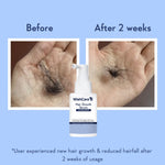 Thumbnail for Wishcare Hair Growth Serum Concentrate In-Vivo Tested Redensyl, Anagain, Biotin,Keratin & Rice Water