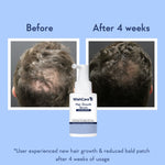 Thumbnail for Wishcare Hair Growth Serum Concentrate In-Vivo Tested Redensyl, Anagain, Biotin,Keratin & Rice Water