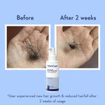 Thumbnail for WishCare Hair Growth Serum Concentrate with Redensyl & Rosemary-In-Vivo Tested-Controls Hairfall