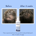 Thumbnail for WishCare Hair Growth Serum Concentrate with Redensyl & Rosemary-In-Vivo Tested-Controls Hairfall