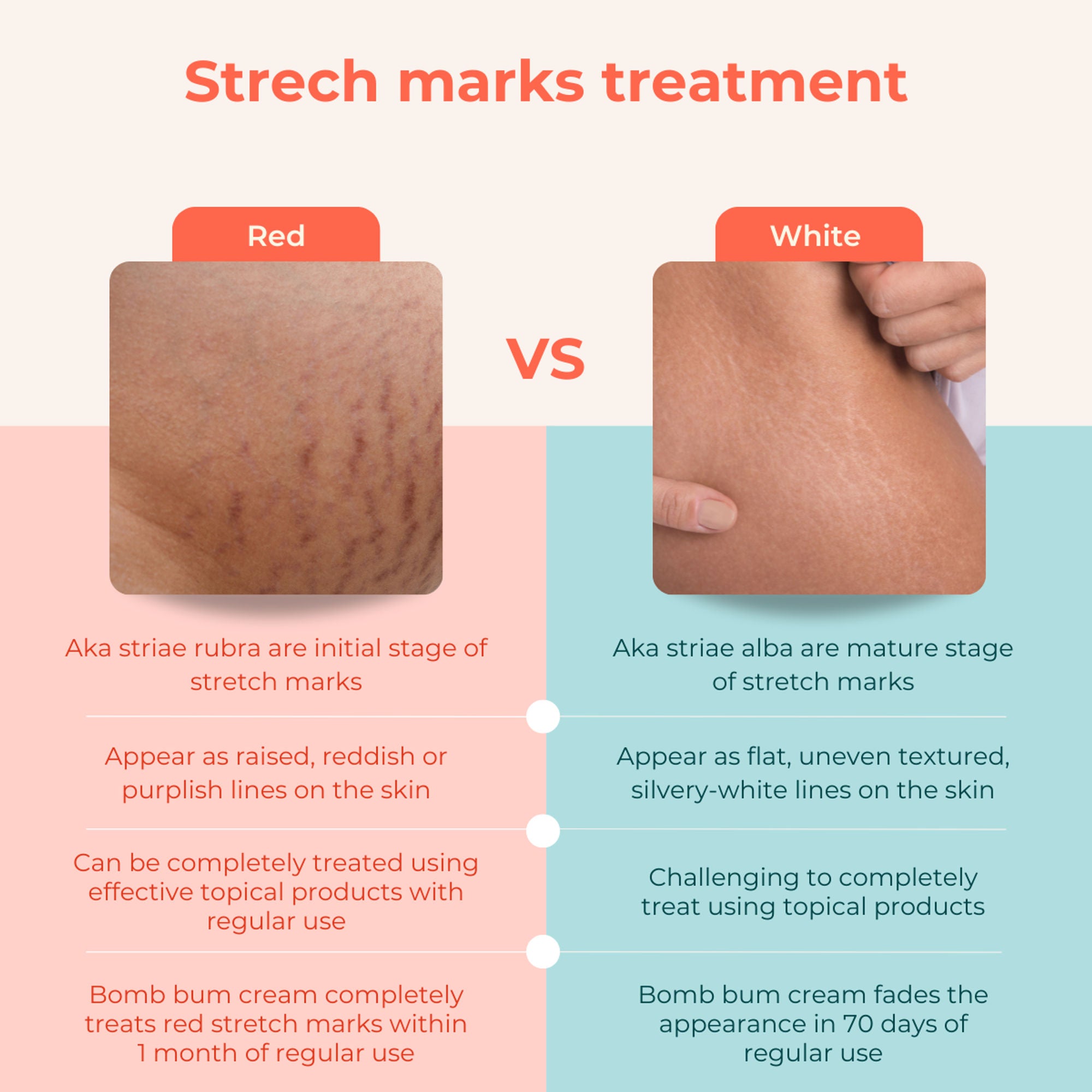 Skinvest Bomb bum cream for Stretch Marks + Cellulite - Distacart