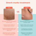 Thumbnail for Skinvest Bomb bum cream for Stretch Marks + Cellulite - Distacart