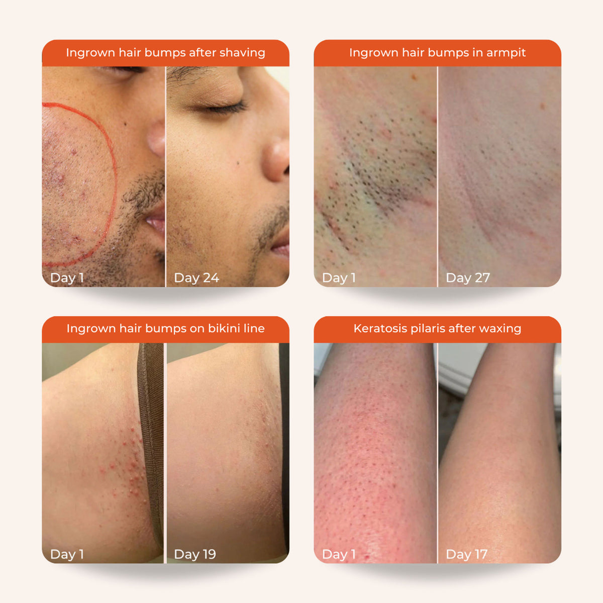 Skinvest Bye Bye Bumps - Exfoliating Body Mist - Distacart