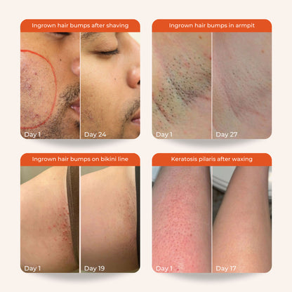 Skinvest Bye Bye Bumps - Exfoliating Body Mist - Distacart