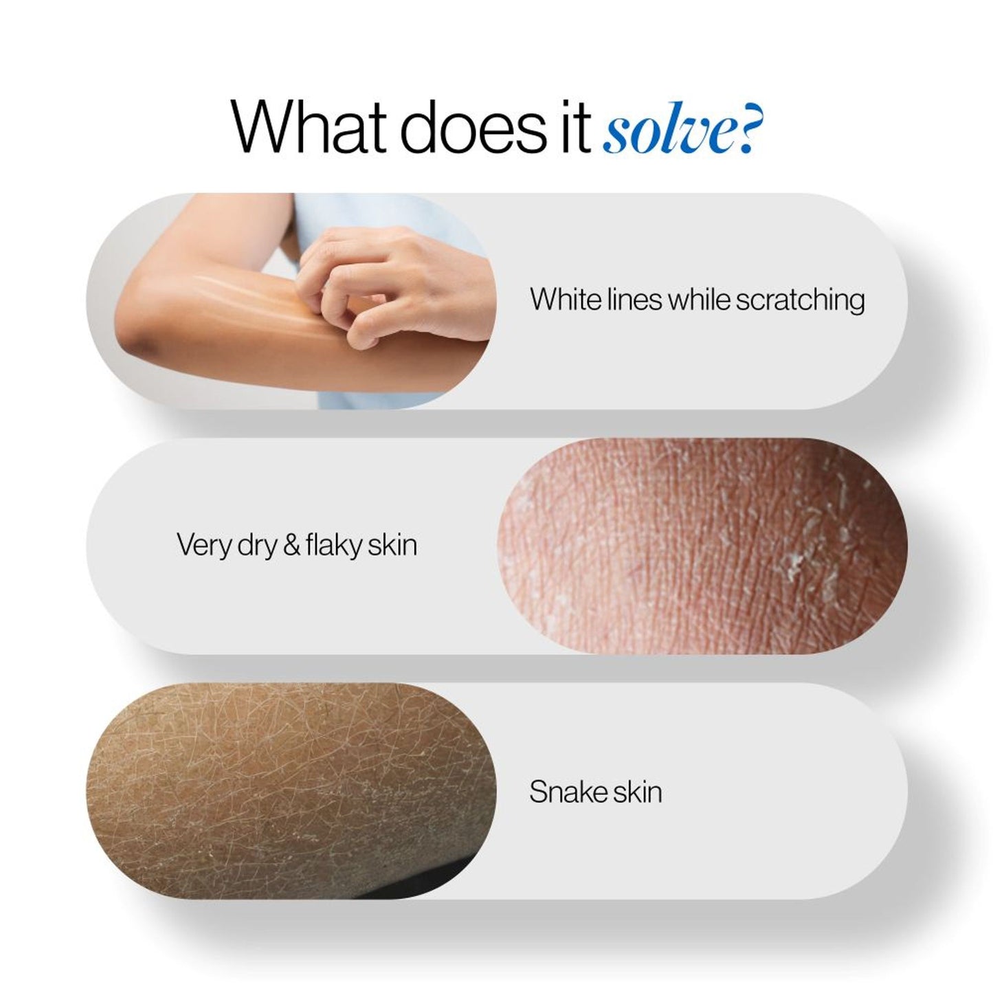 BeBodywise 20% Urea Body Lotion - Advanced Formulation - Dista