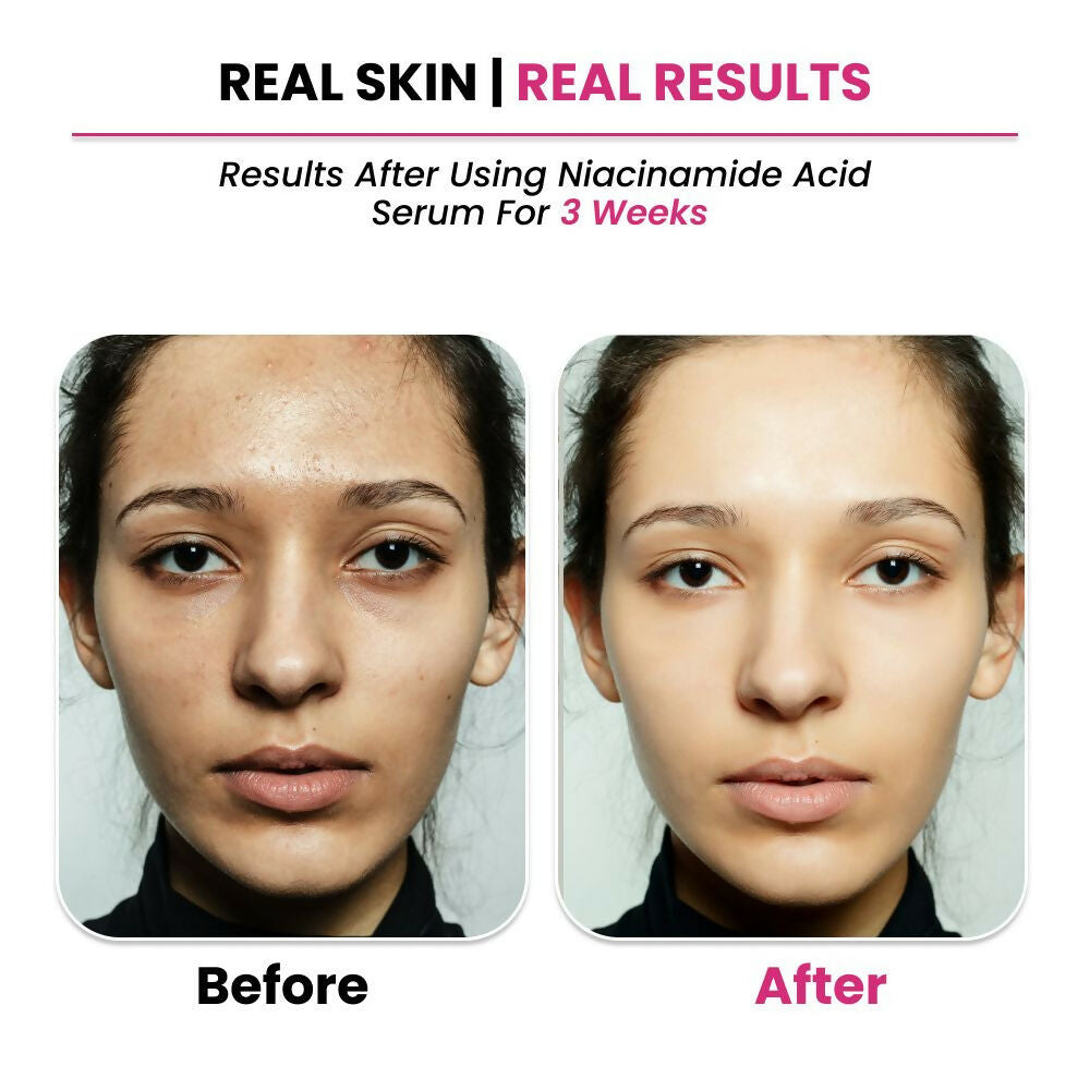 Thriveco 10% Niacinamide + 1% Zinc Pca Serum - Distacart