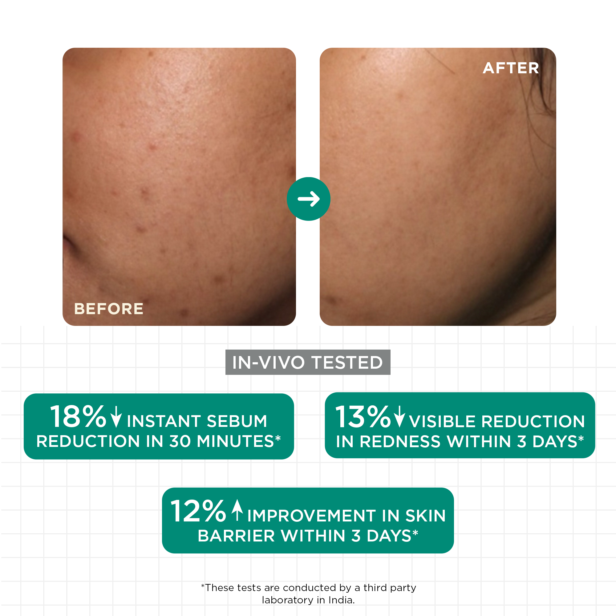 SkinQ Acne & Oil Control Serum - Distacart