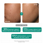 Thumbnail for SkinQ Acne & Oil Control Serum - Distacart