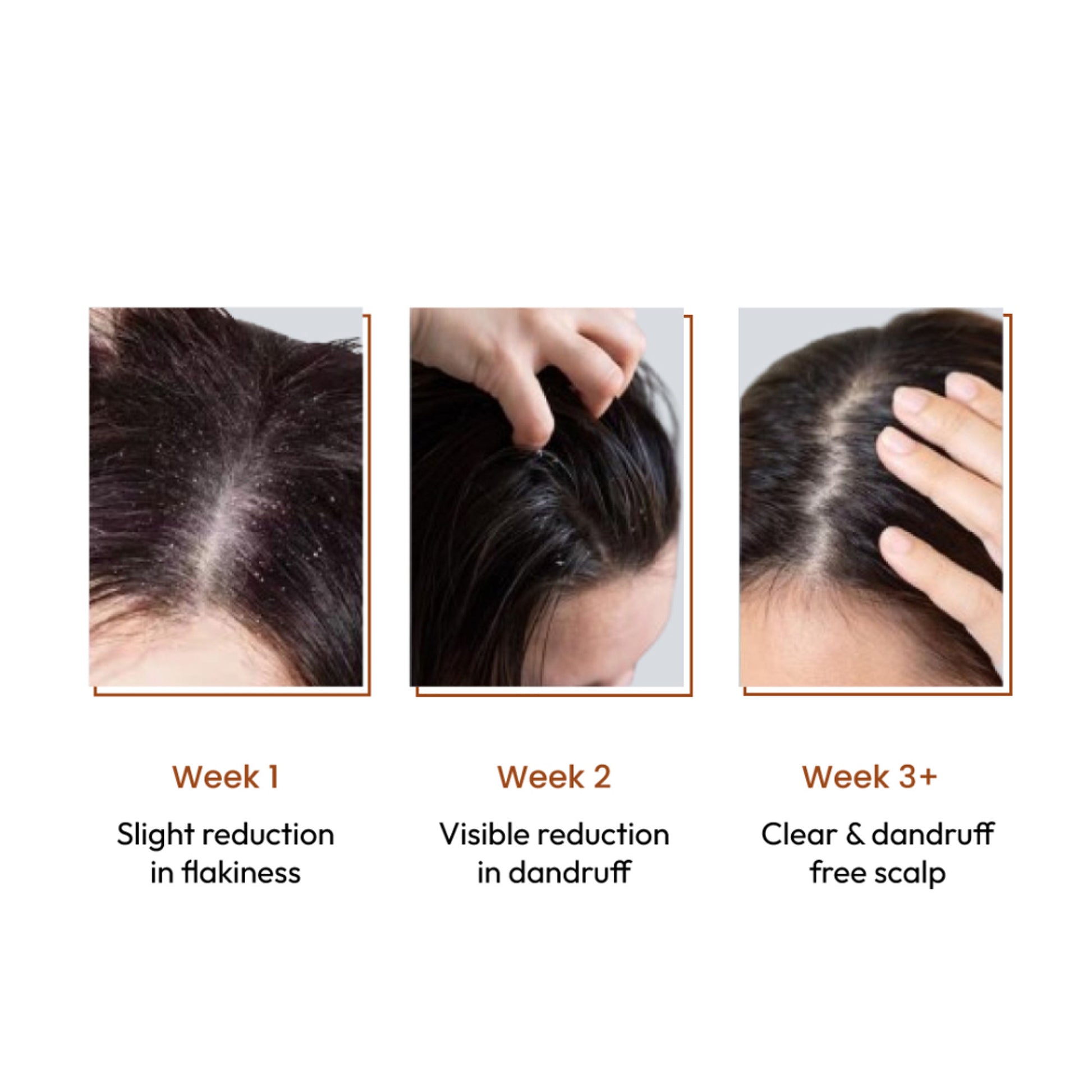 SANCTUS 4% Dandelix Pro Anti-Dandruff Hair Serum For Scalp - Distacart