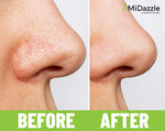 Thumbnail for MiDazzle Black Head Remover MIBR3301 - Distacart