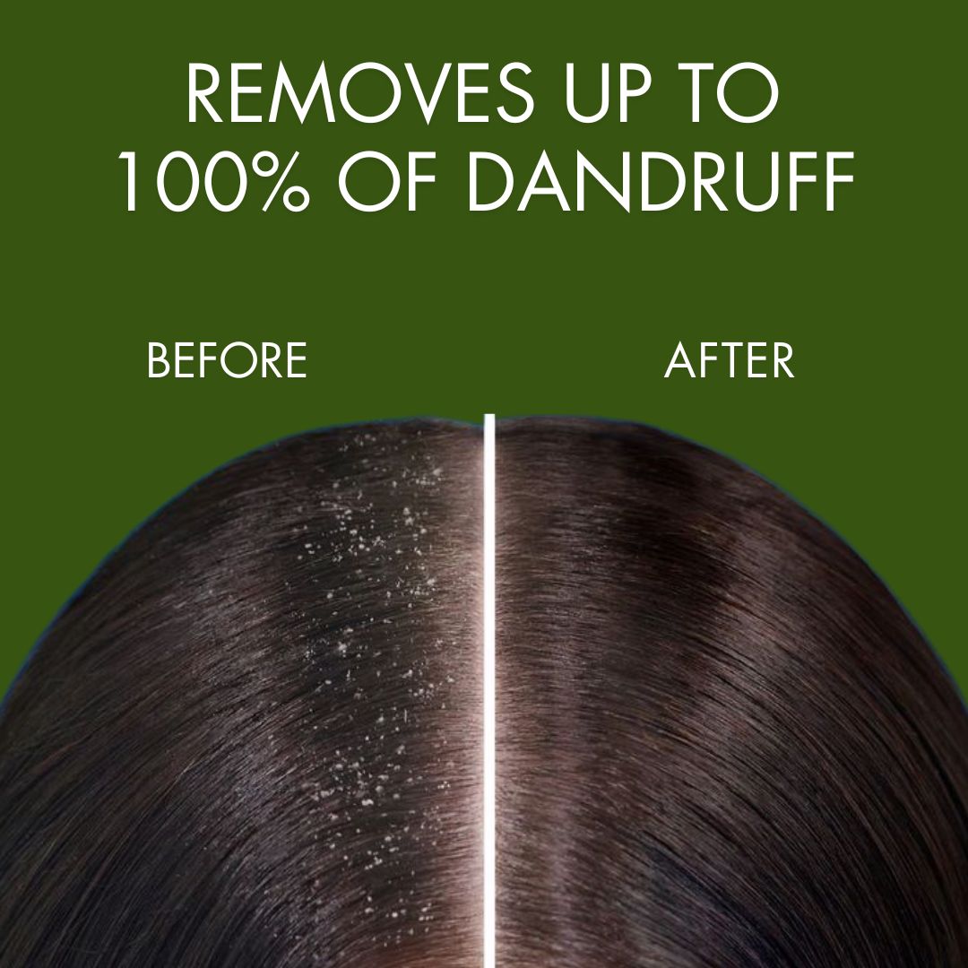 Samisha Anti Dandruff Spray - Distacart