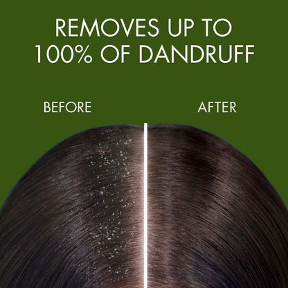 Samisha Anti Dandruff Spray - Distacart