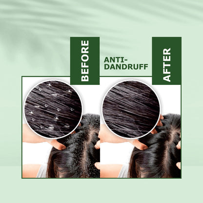 Nuerma Science Anti-Dandruff Oil | Rejuvenate Your Scalp, Rediscover Confidence - Distacart