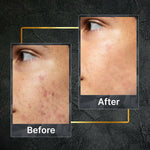 Thumbnail for Tru Hair & Skin Nanotechnology Facewash For Sensitive-Acne Prone Skin