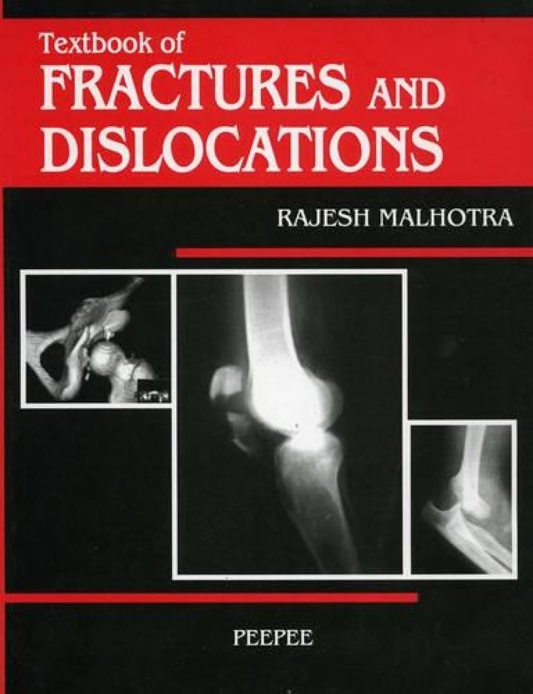 Textbook Of Fractures And Dislocations: Volume 1-Malhotra - Dista