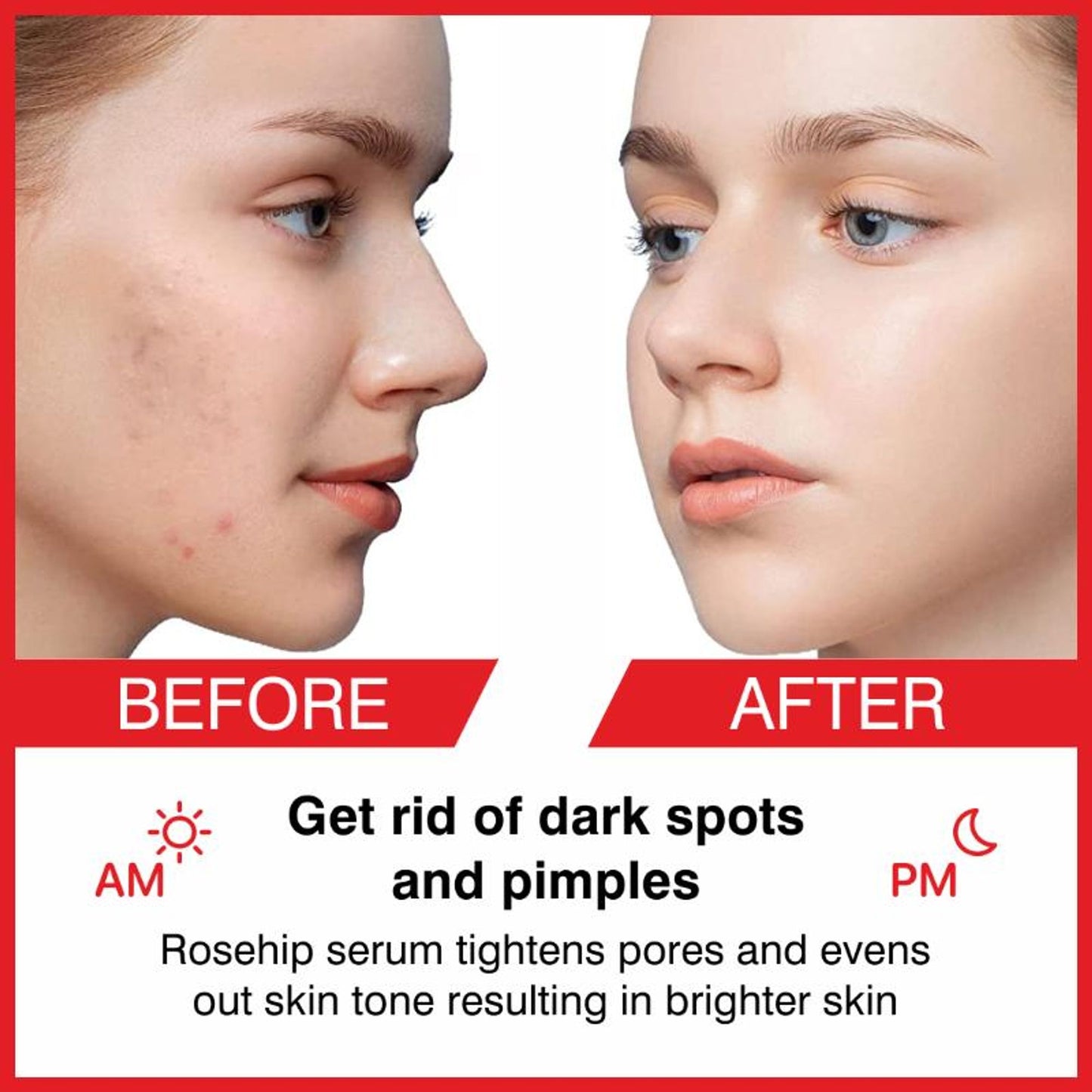She Essentials Rosehip Face Serum For Tan Pigmentation & Blemish Control