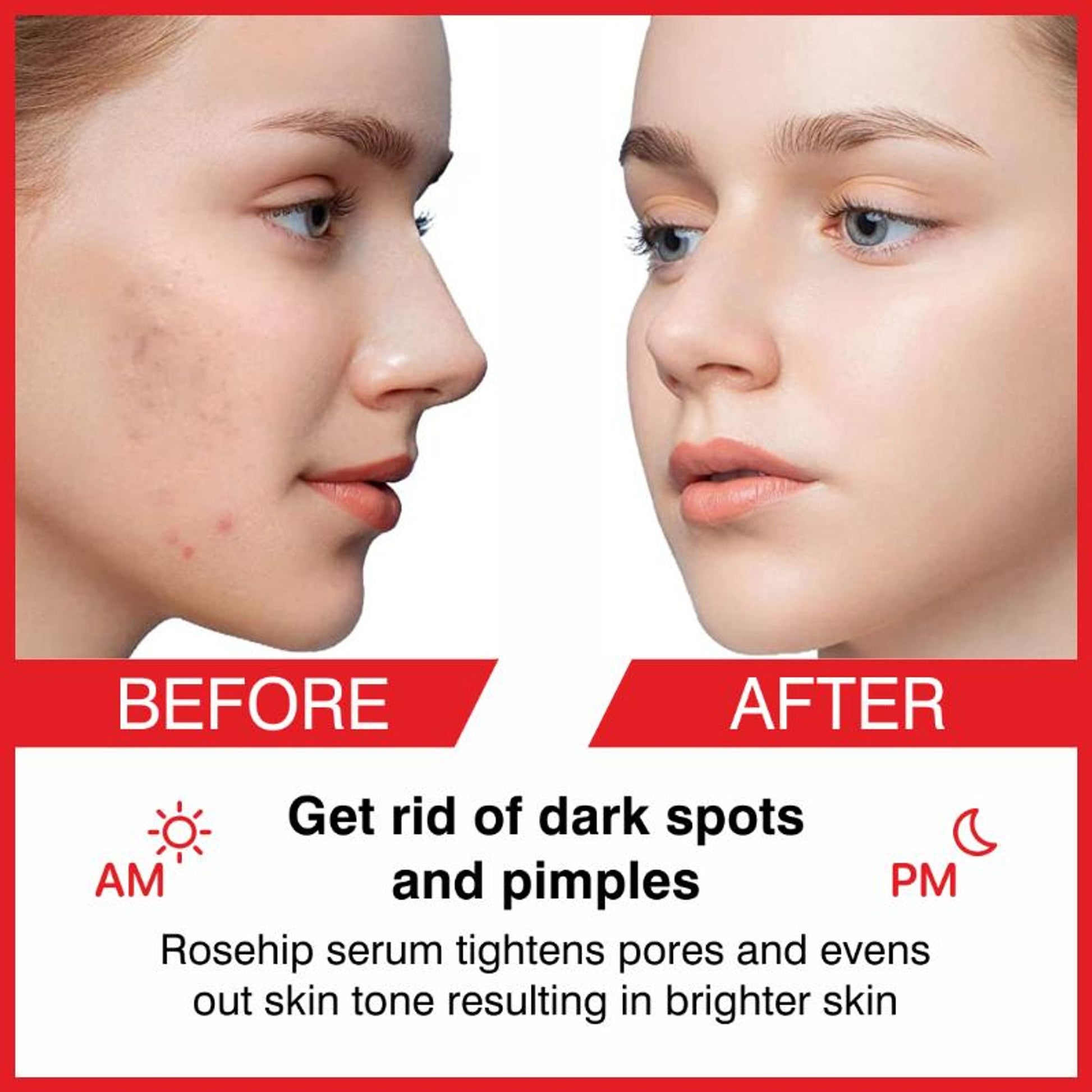 She Essentials Rosehip Face Serum For Tan Pigmentation & Blemish Control