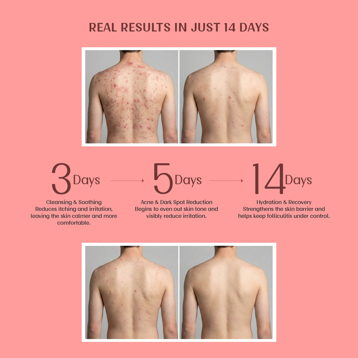 Velleja Exfoliating Body Wash with Salicylic Acid for Body Acne & Rough Bumpy Skin | Reduce Strawberry Legs - Dista