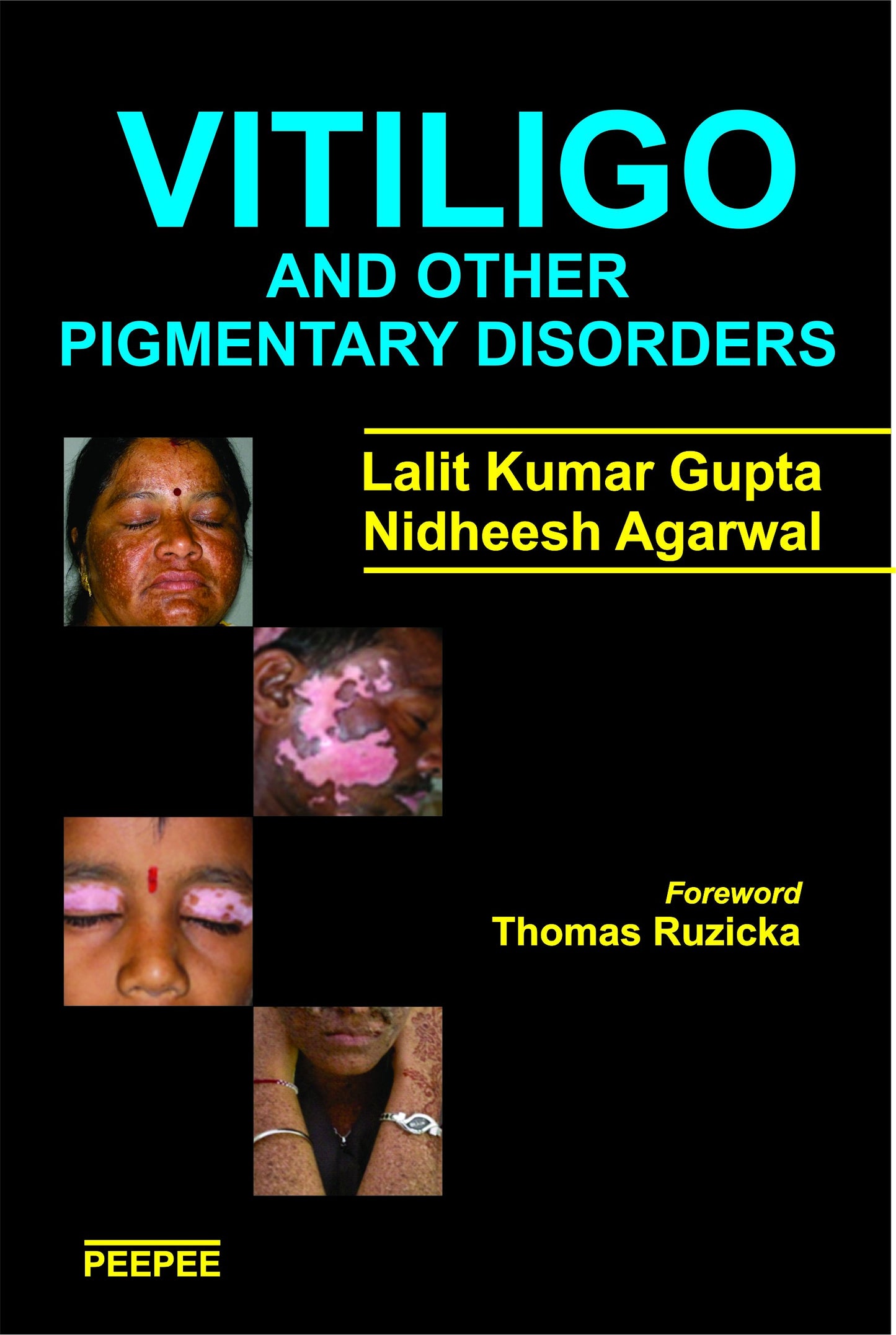 Vitiligo And Other Pigmentary Disorders-Lalit Gupta - Dista