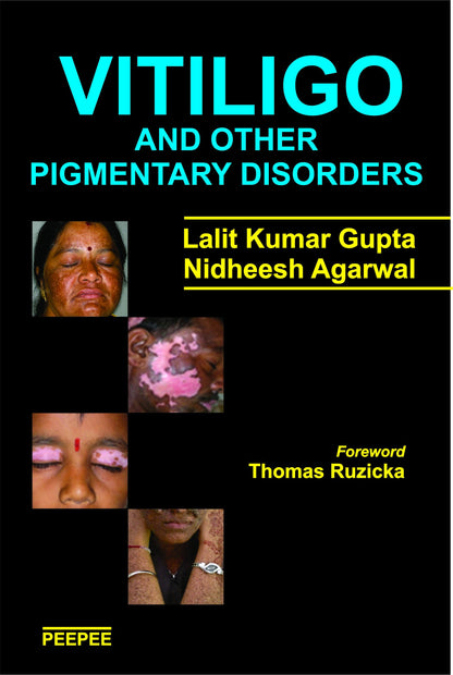 Vitiligo And Other Pigmentary Disorders-Lalit Gupta - Dista