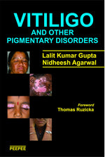 Thumbnail for Vitiligo And Other Pigmentary Disorders-Lalit Gupta - Dista
