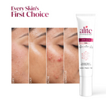 Thumbnail for Alite Anti Acne Gel - Distacart