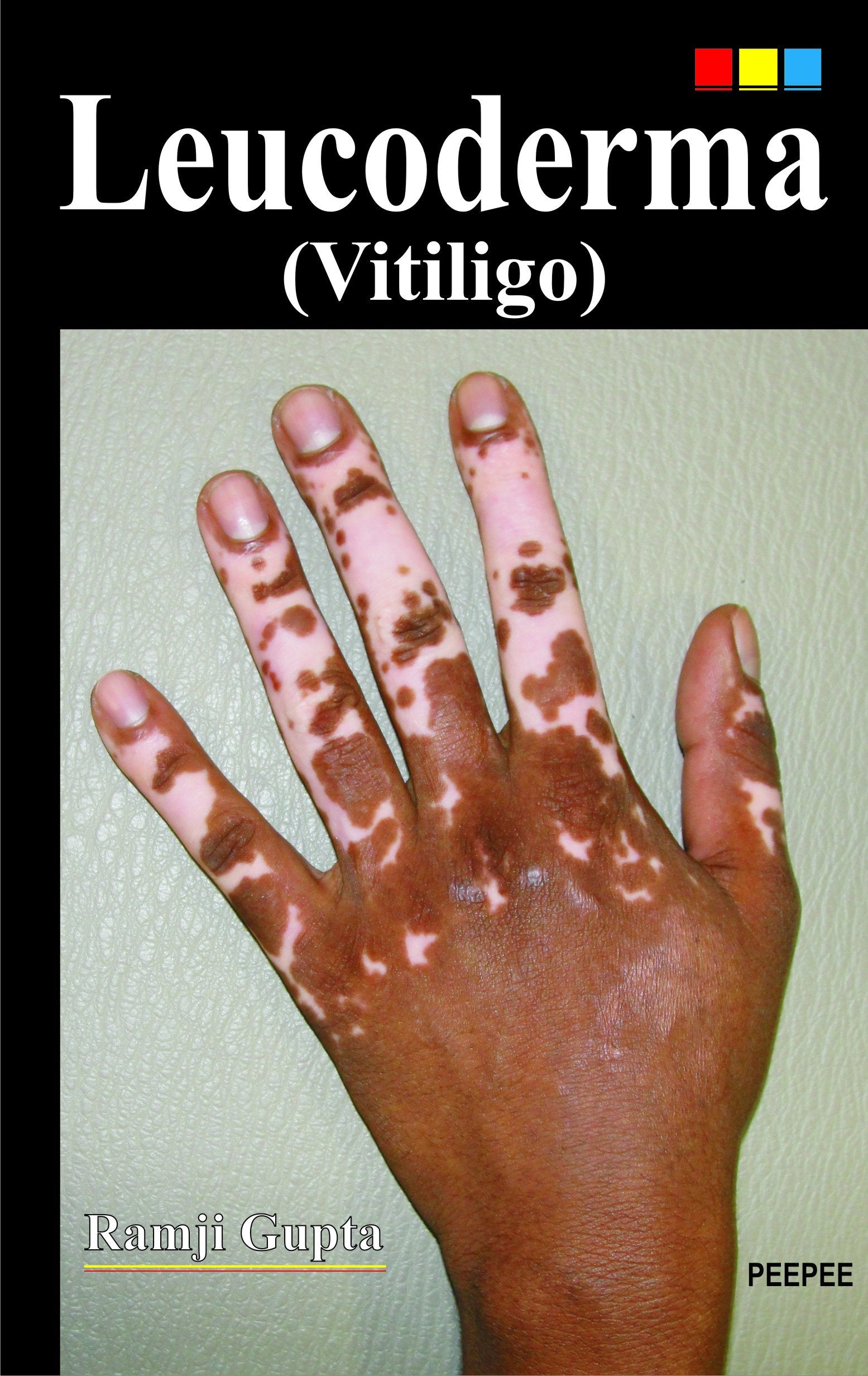 Leucoderma (Vitiligo)-Ramji Gupta - Dista
