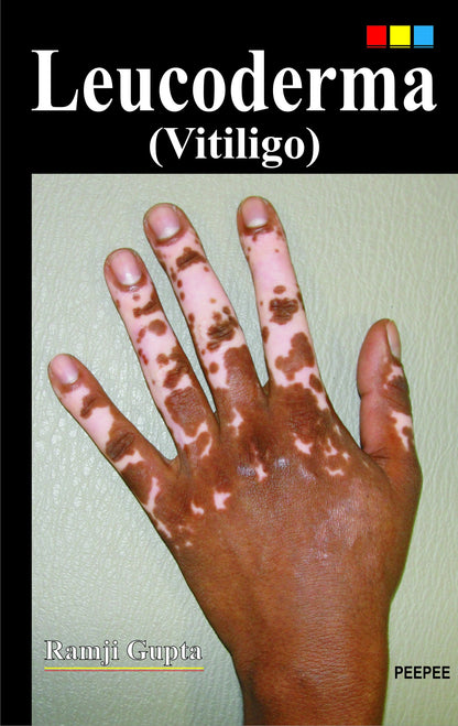 Leucoderma (Vitiligo)-Ramji Gupta - Dista
