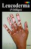 Leucoderma (Vitiligo)-Ramji Gupta - Dista