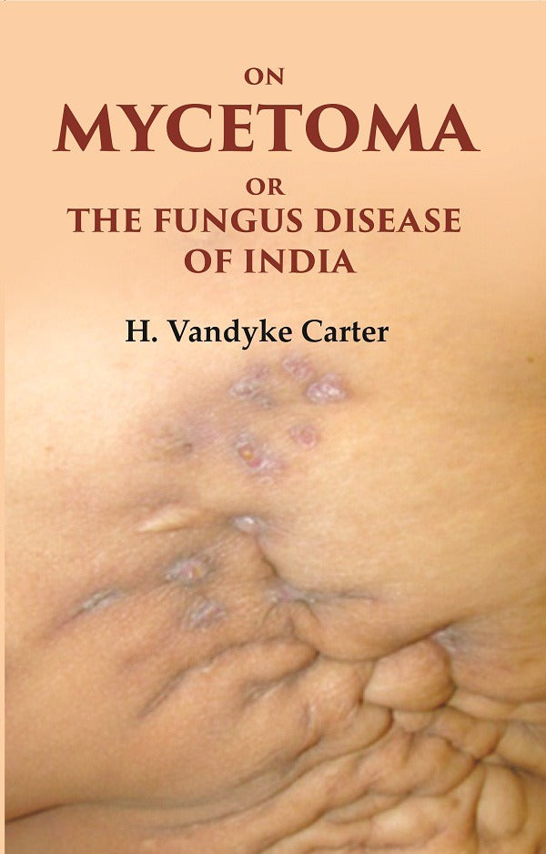 On Mycetoma or the Fungus Disease of India - Gyan Books - Distacart