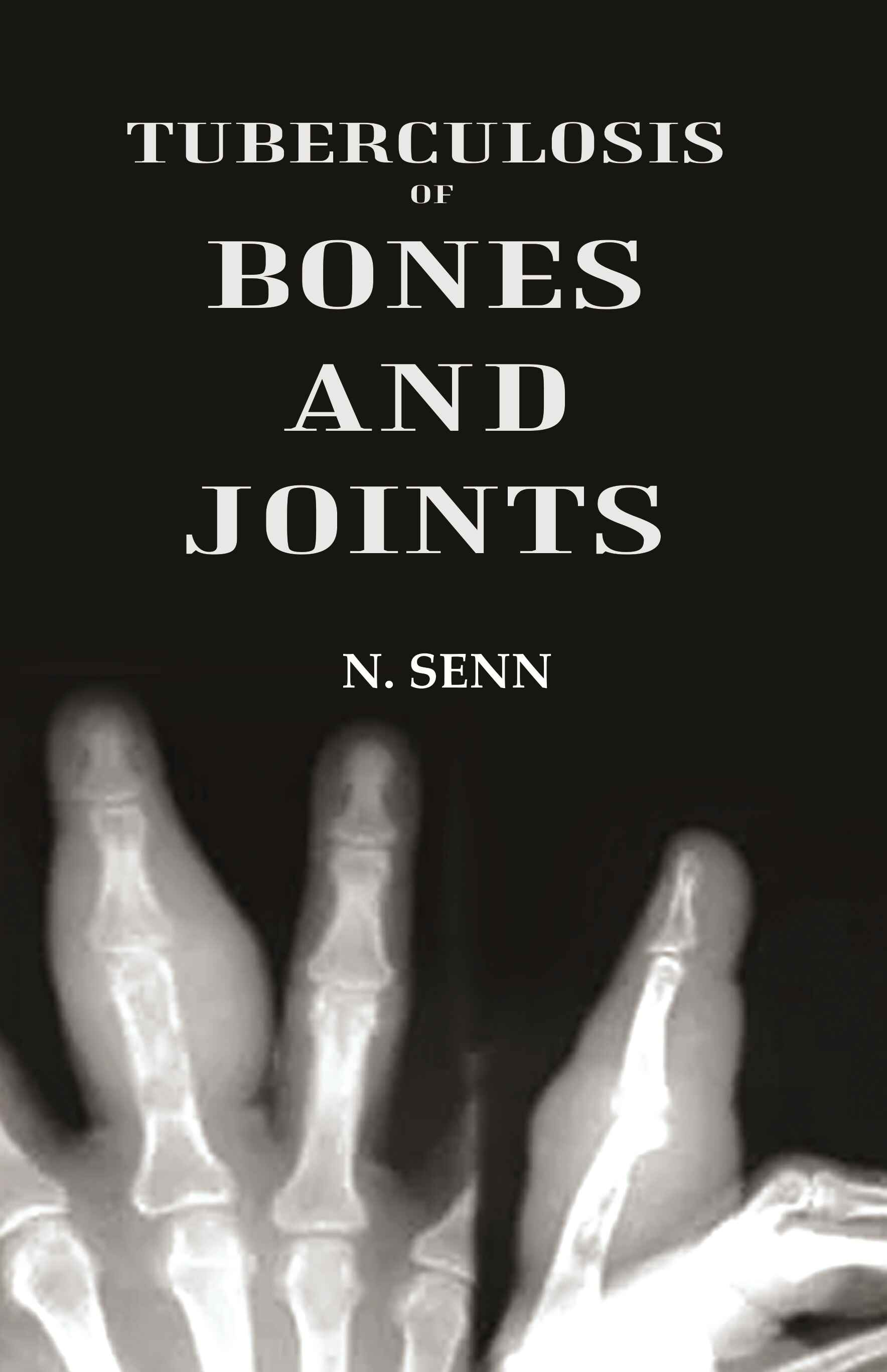 Tuberculosis of Bones and Joints - Gyan Books - Distacart