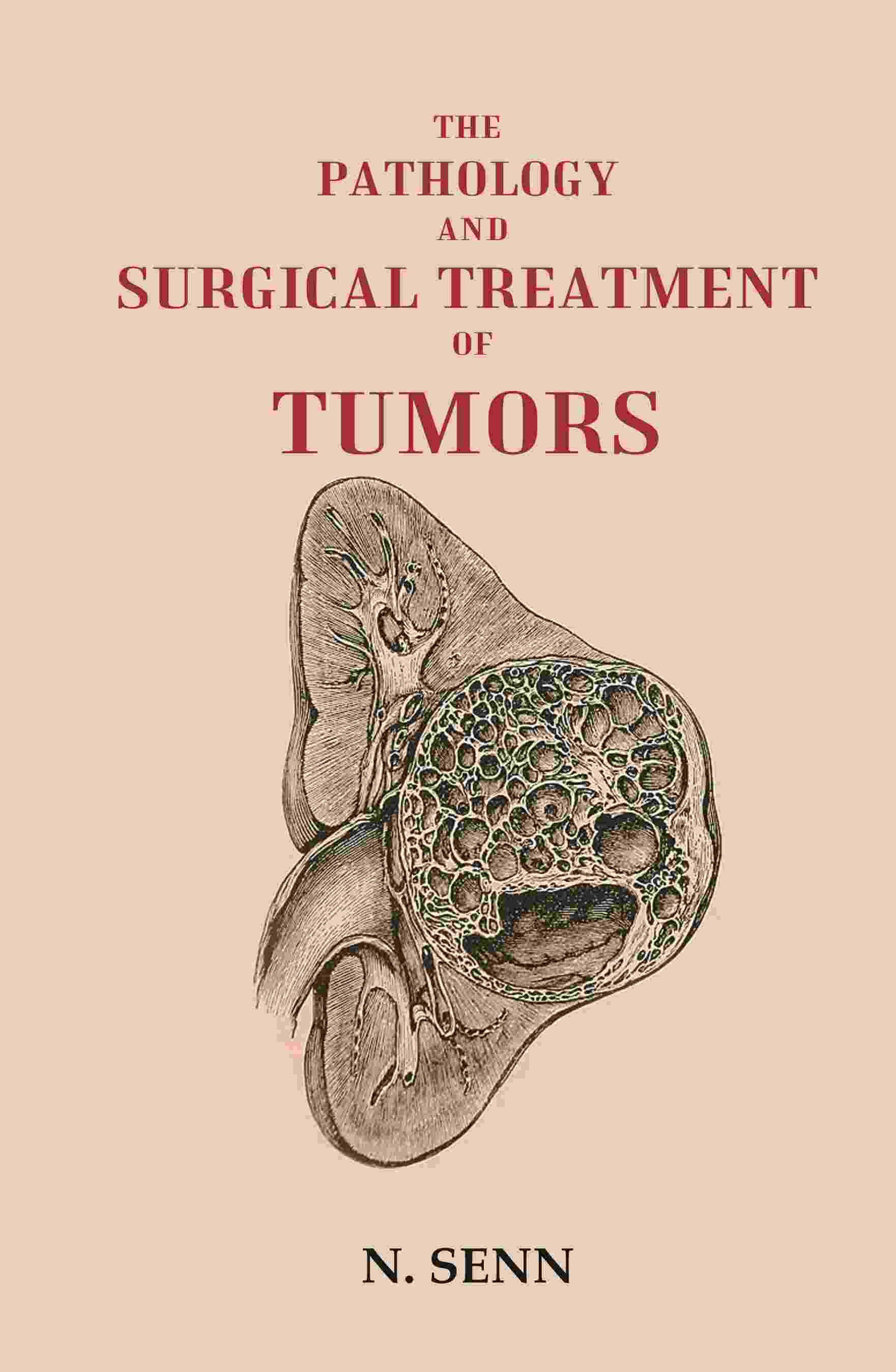 The Pathology and Surgical Treatment of Tumors - Gyan Books - Distacart