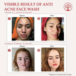 Thumbnail for Ivory Natural Acne & Dark Spot Face Wash For Moisturize, Replenish, And Promote Skin Clarity - Distacart