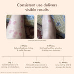 Thumbnail for VedicDerm Oleander's Oil for Psoriasis, Eczema, and Atopic Dermatitis - Distacart