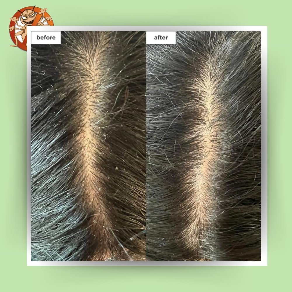 Botanical Luxuriate Tea Tree Natural Anti Lice and Nits Shampoo - Dista